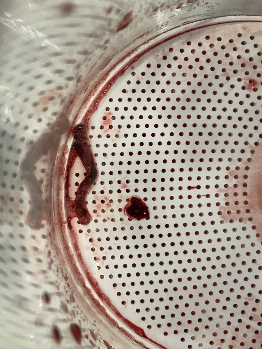 Mechanical Thrombectomy Team NUH (@thrombectomynuh) on Twitter photo Photos from last Saturday's case. These clots have caused an ICA tandem M1 occlusion. Mechanical thrombectomy was performed using combined technique (suction + clot retriever). #mechanicalthrombectomy Photos from last Saturday's case. These clots have caused an ICA tandem M1 occlusion. Mechanical thrombectomy was performed using combined technique (suction + clot retriever). #mechanicalthrombectomy