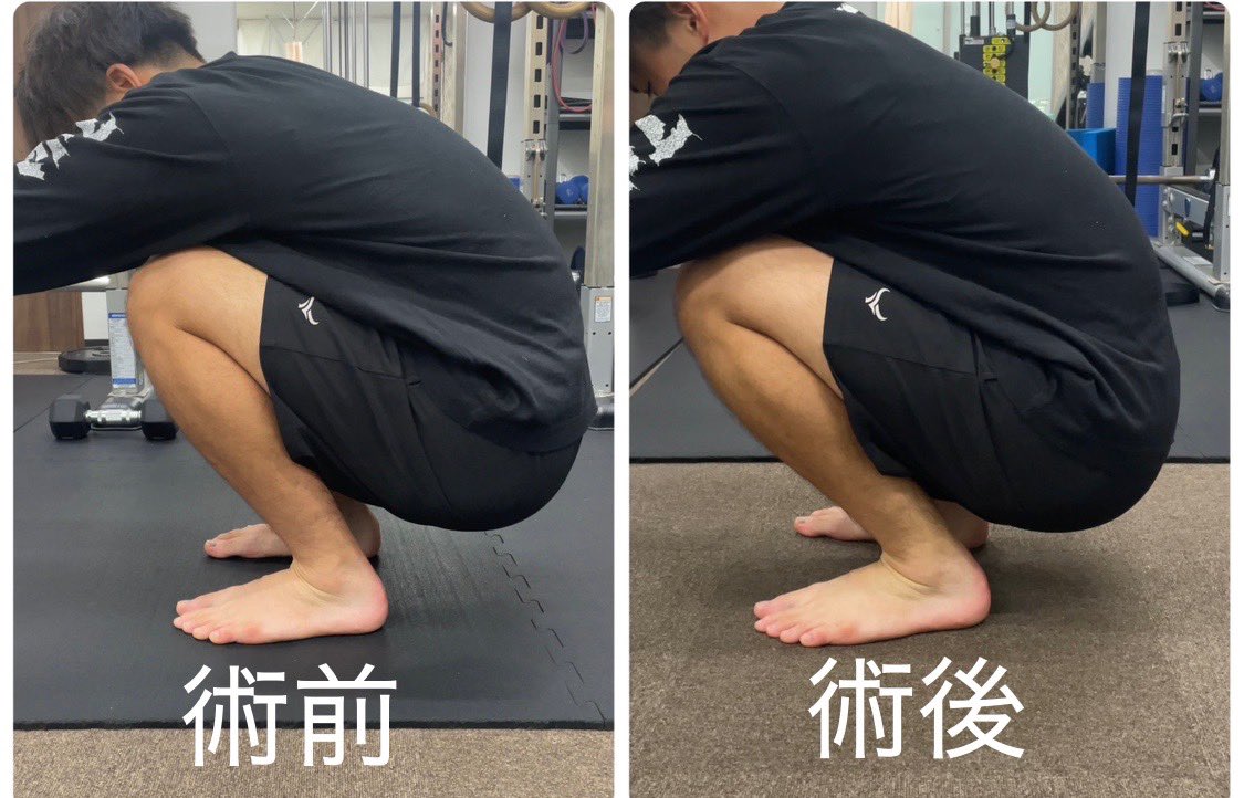 アメフトトップリーグで活躍中の選手が、身体の調整に来てくれました。一つのエラーが、様々な箇所に代償して働いてたので、しっかりとエラーを対処させていただきました。