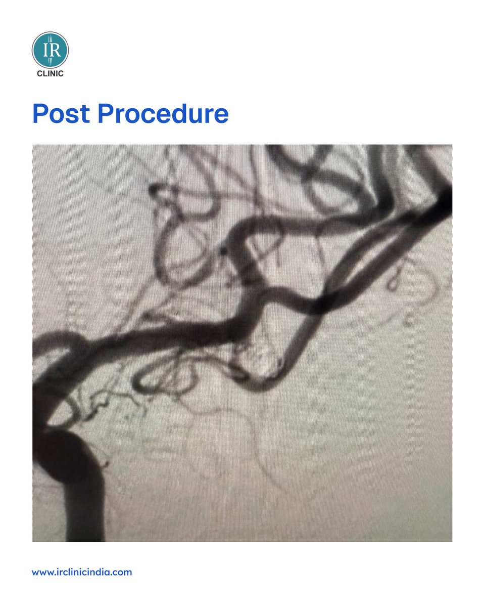 irclinic2018's tweet image. A 49-year-old woman had a severe brain bleed from a ruptured MCA aneurysm.

IR Clinic's Dr. Vasav &amp;amp; Dr. Jigar performed immediate aneurysm coiling, securing the rupture &amp;amp; preventing life-threatening hemorrhage. Every second counted. Success!

#BrainAneurysm #NeuroIR #Coiling