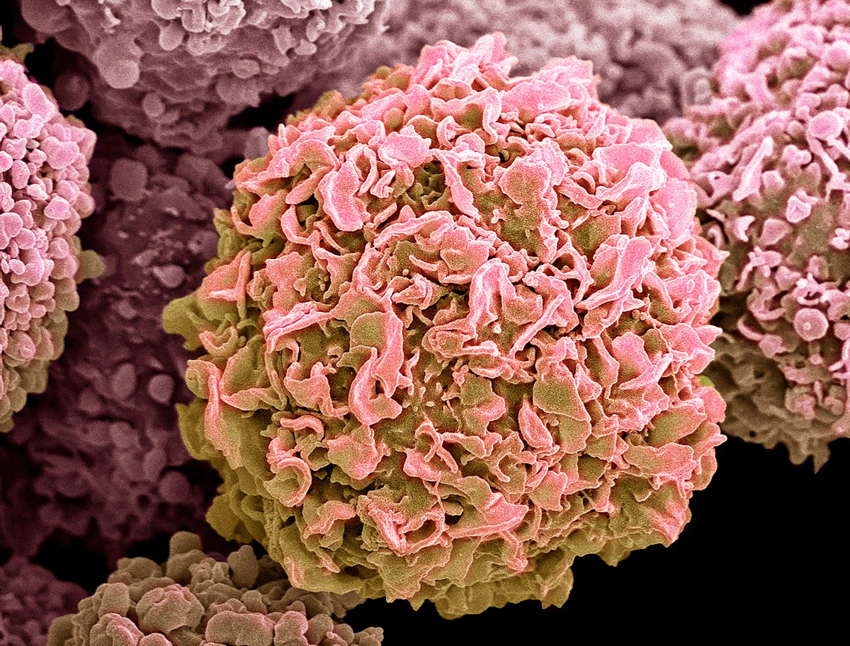 quay_dr's tweet photo. $ATOS has requested a Type C meeting with the @US_FDA to align on accelerating development of low-dose (Z)-endoxifen for #breastcancer risk reduction.

Why this matters:
- There are 1.6 to 2.1 million tamoxifen prescriptions filled annually. 
- About 1 million women are currently on #adjuvantendocrinetherapy. Another 80,000 women are on therapy post-DCIS.
- And 120,000 use #SERMs for primary prevention in high-risk settings.

A favorable #FDA alignment could bring (Z)-endoxifen to women years sooner, at lower cost, and with more predictable, faster acting therapy than current agents.

Follow @atossainc on @X and learn more on the #ATOS website: https://t.co/LhwMZy5iAT