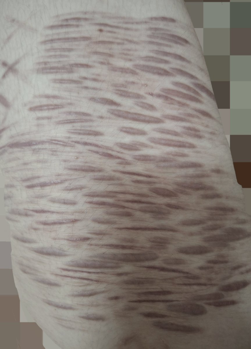 okeoke299091's tweet photo. Right thigh #selfharm https://t.co/cMn8keg5ff