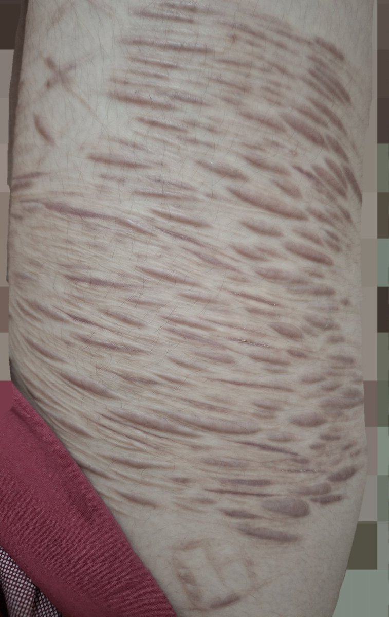 okeoke299091's tweet photo. Right thigh #selfharm https://t.co/cMn8keg5ff