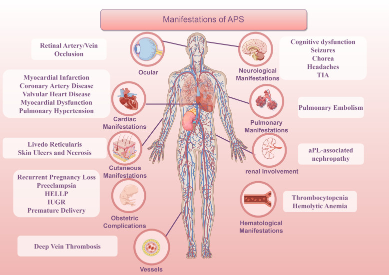 APSsupportUK's tweet image. Novel insights into #APS extend beyond #Thrombosis to NETosis, #ComplementActivation and #MicrobiomeDysbiosis. The 2023 ACR/EULAR criteria refine diagnosis. Adjunctive therapies such as HCQ, rituximab and eculizumab show therapeutic potential: pmc.ncbi.nlm.nih.gov/articles/PMC12… #MedTwitter