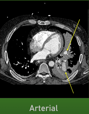 RadiologyACR's tweet image. 📖 #RadExam Study Guide 📖

A 61-year-old male presented to the trauma bay after a self-inflicted GSW to the left hemithorax. What is the most likely diagnosis? 

Check out this #IRad case on our YouTube channel: bit.ly/47ftmnm