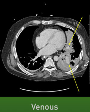 RadiologyACR's tweet image. 📖 #RadExam Study Guide 📖

A 61-year-old male presented to the trauma bay after a self-inflicted GSW to the left hemithorax. What is the most likely diagnosis? 

Check out this #IRad case on our YouTube channel: bit.ly/47ftmnm