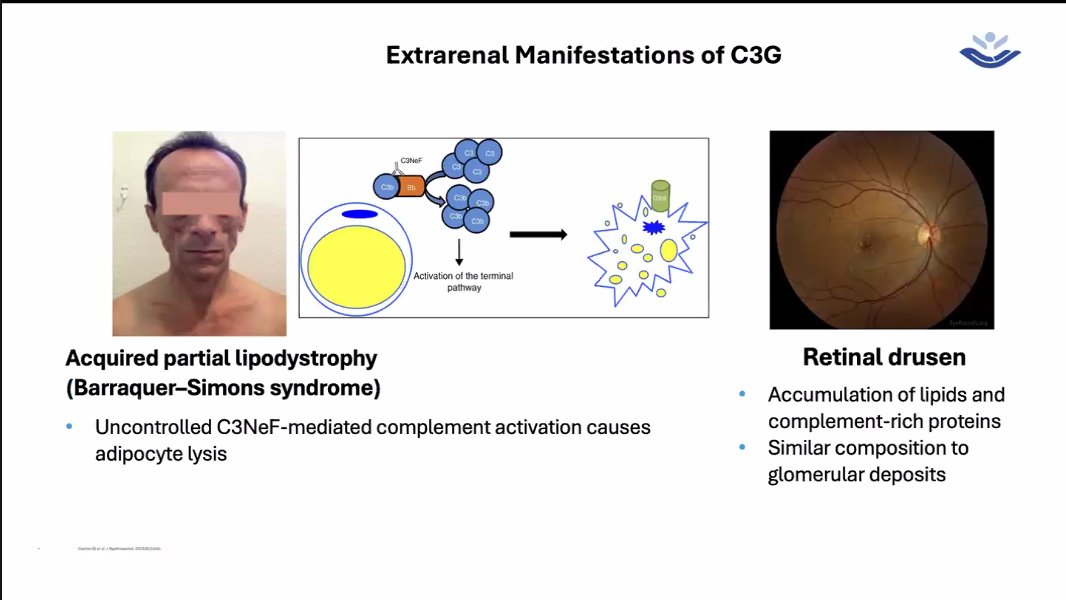 stephanietr612's tweet image. @ISNeducation Webinar: Understanding C3G
From USA @anuja_java
🩺Clinical features of C3G
👁️Extrarenal features: Acquired partial lipodystrophy & Retinal drusen
@ISNkidneycare
#ISNWebinar
