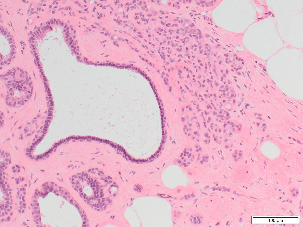 Breast biopsy for distortion.