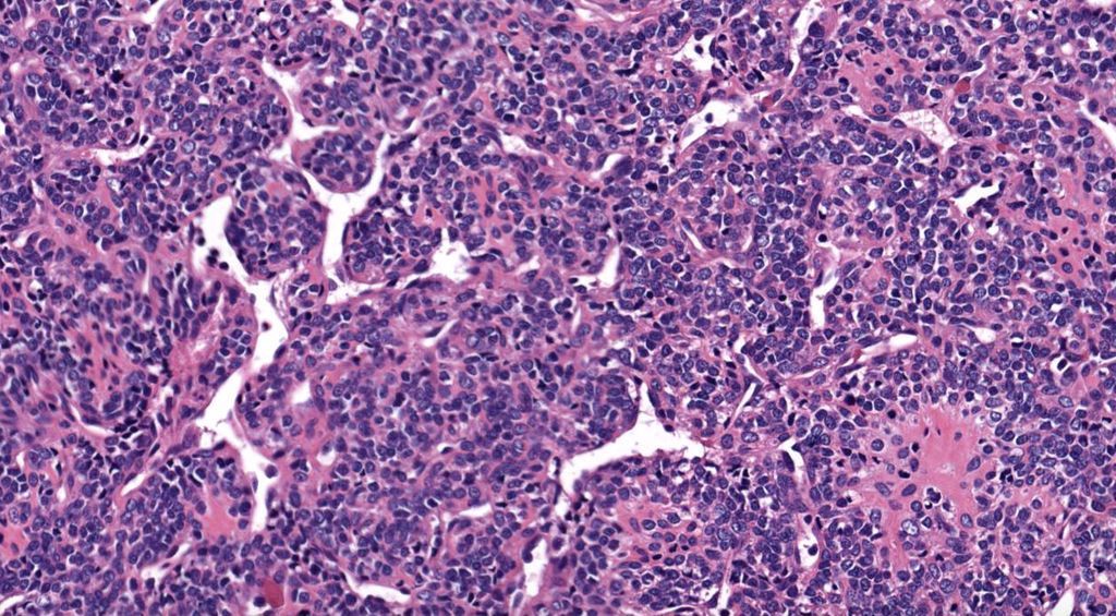 30 yo F with intramuscular thigh mass. No connection to bone on imaging. 
Answer ✅ youtube.com/watch?v=kb737f… 
WSI digital slide: kikoxp.com/posts/5130. 
#BSTpath #pathologists #pathology #pathTwitter