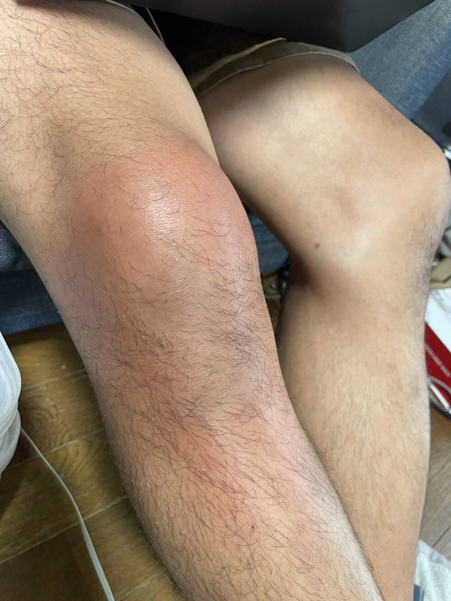 【蜂窩織炎】という病気が再発しました。
膝に菌が入り赤く炎症し痛みを伴います。

膝にばい菌が入る事によって発症しますが怪我をした記憶がないので、疲れやストレスなどが原因だと思われます。

最近、疲れもあり暫くオナ禁した方がよさそうです。

 #男の美學
