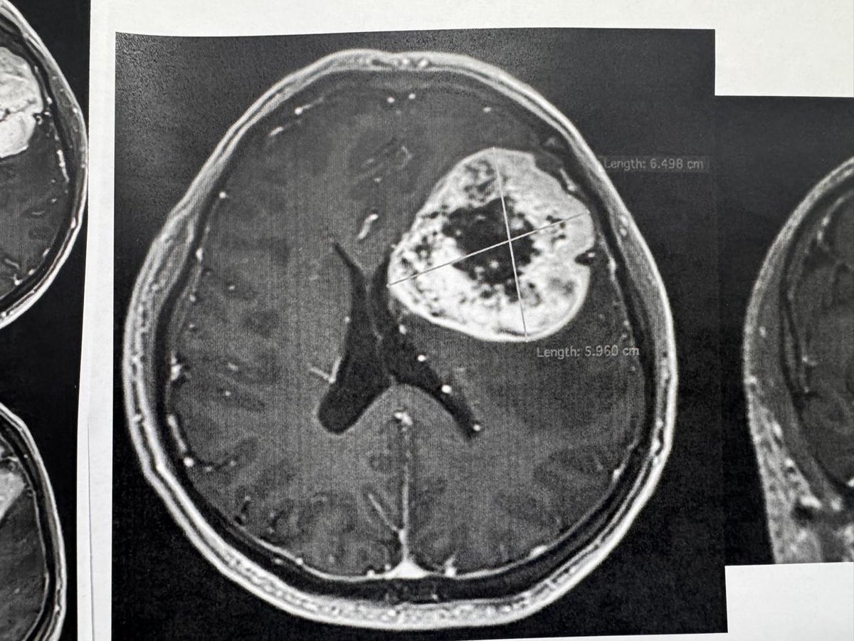📰 #COMUNICADO
Retiran tumor cerebral con técnica de paciente despierto en el CMN “20 de Noviembre” del ISSSTE.
🔗n9.cl/5sh20s