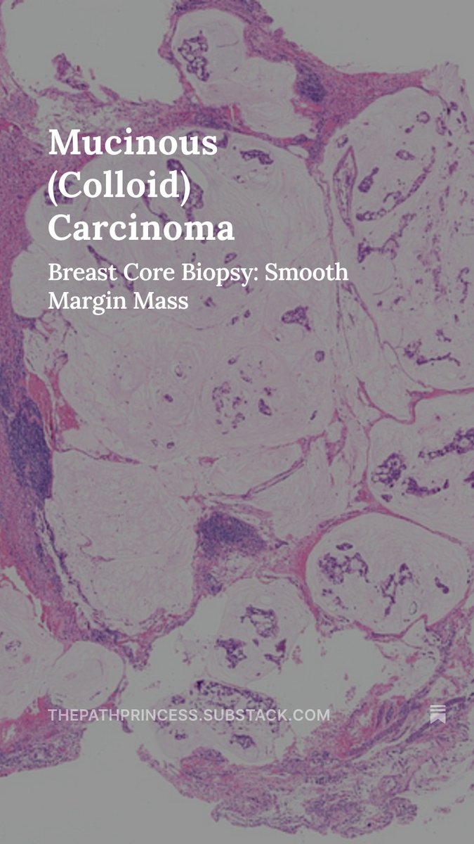 Mucin pools and a pushing, smooth border. 

thepathprincess.substack.com/p/mucinous-col…

It's the look of mucinous carcinoma. 🔬

#pathology #pathologist #breastpath #pathX #pathtwitter