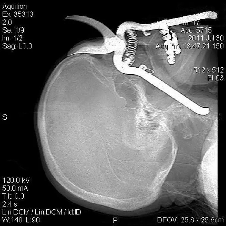 AUCHealth's tweet photo. Accidents can happen in an instant. This man tripped while doing yard work and was impaled by his pruning shears through his eye socket and neck.

After removal, he had slight swelling in his eyelids and minor double vision, but is otherwise OK and made a full recovery.

Yard tools and power equipment can be extremely dangerous. Always stay alert, wear protective gear, and never rush.