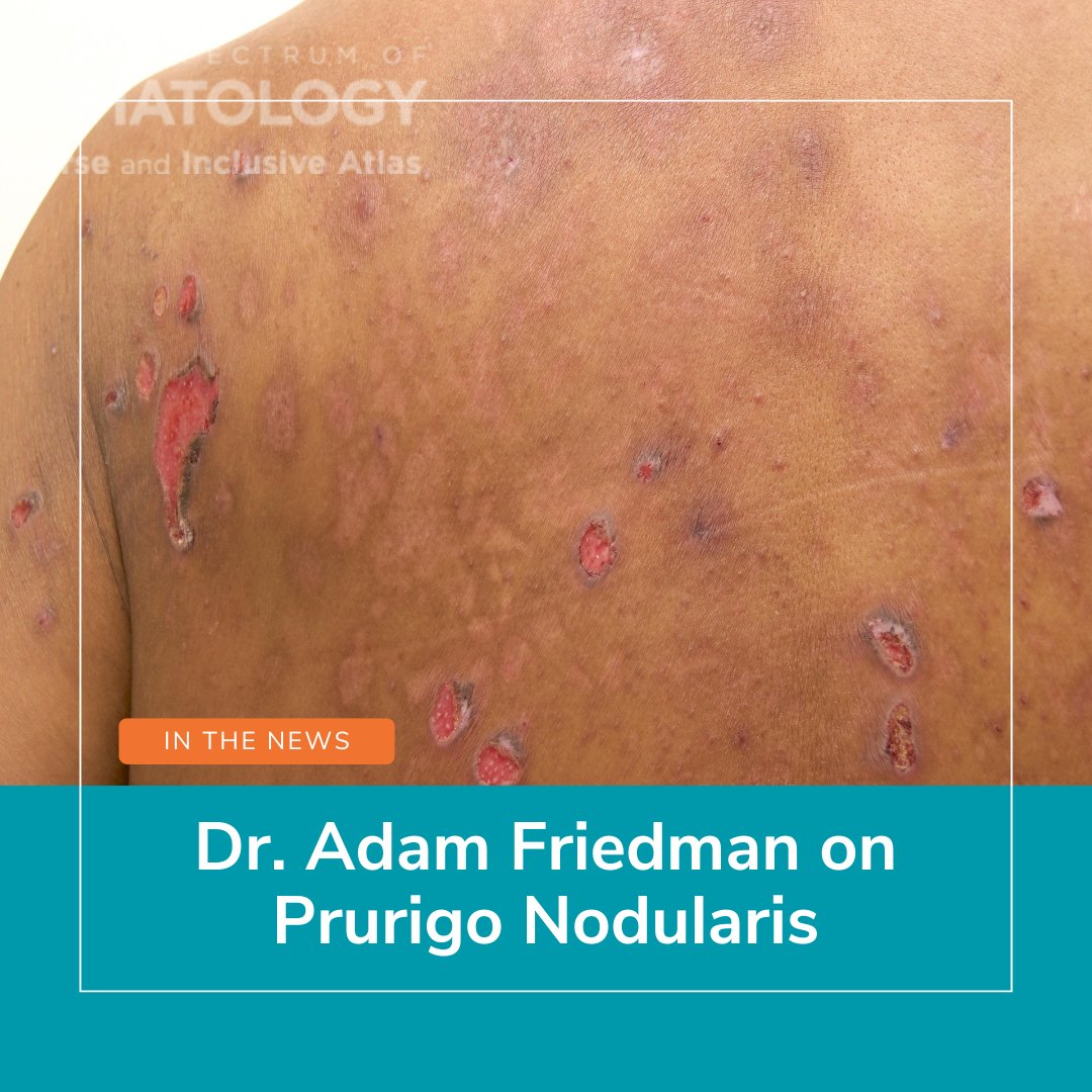 ODAC Conference Co-Chair Dr. Adam Friedman spoke with The Dermatology Digest about his ODAC 2025 presentation on PN. 

Learn what’s new in the understanding of PN and what to consider in a DDx: ow.ly/s6Av50X3UyK

#PrurigoNodularis #DermatologyEducation #SkinDisorders