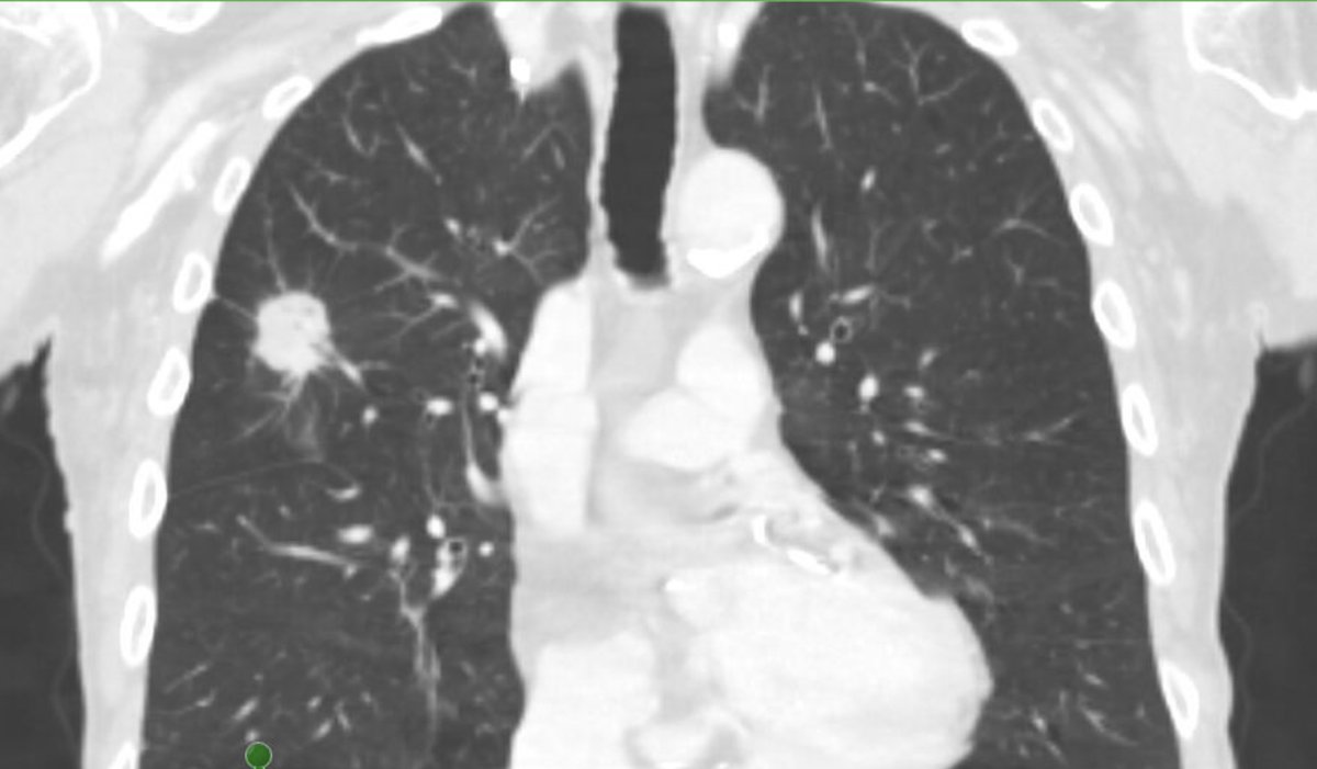 GS_Bronch tweet media