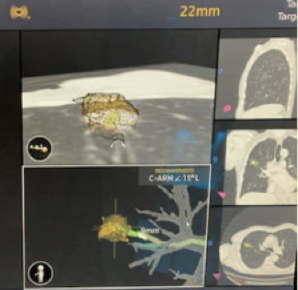 GS_Bronch tweet media