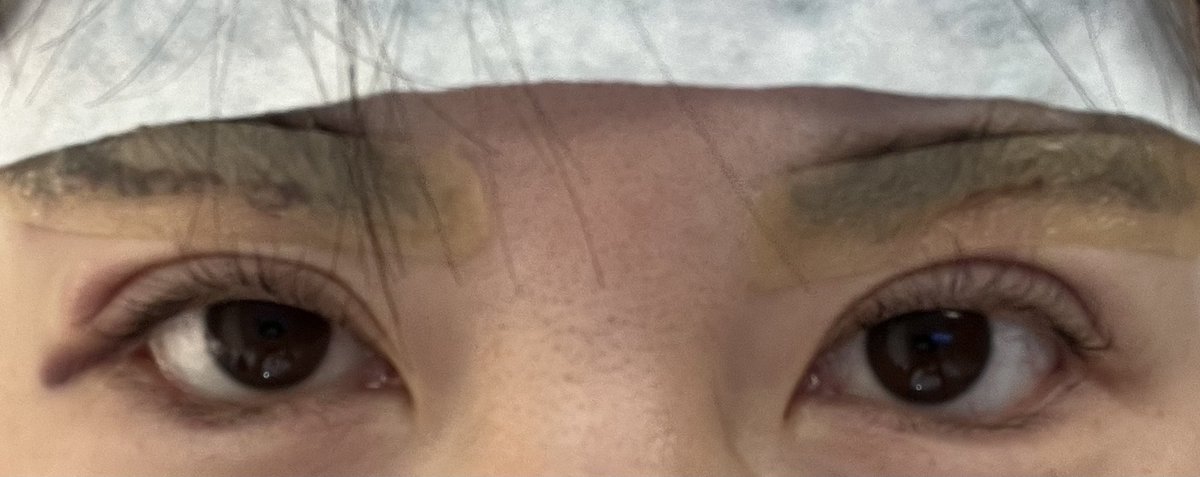 エイペックス、ソン先生で
眉下切開とタレ目形成しました。
睡眠麻酔すると呼吸が浅くて起こされて
命のが優先なので起きたままで手術しよう！
との事でめっちゃ怖かったですが
先生や看護師さんに沢山声かけてもらって
無事終了しました🫶🏻
＠apex_surgery 
術後はやっぱり寝れない🫣