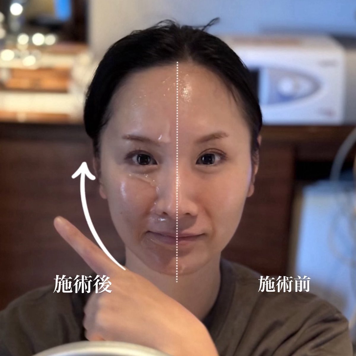 左右でこんなに違う👁️ ˎˊ˗ LDM（水玉リフティング）💧 お肌をキュッ