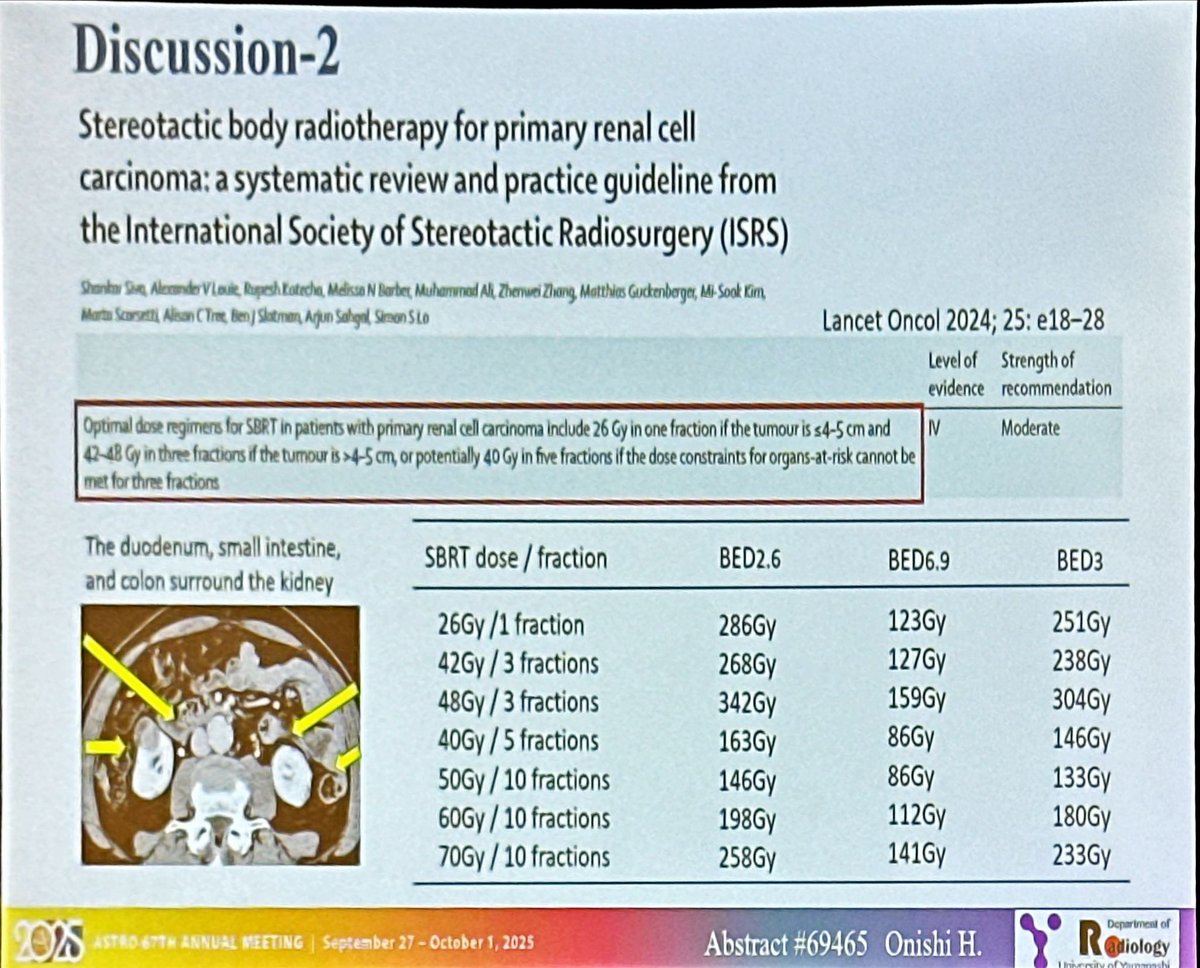 Dr Hiroshi Onishi 🇯🇵 - guru of #lungcancer,l turns his attention to #kcsm

💥 Multicenter phase II (Japan, n=49): SBRT (50–70 Gy/10fx) for localized #kidneycancer

✅ Local control 100% at 5 &amp; 10 yrs
📈 10-yr CSS 87% (97% if SBRT was initial therapy)
🩺 Few grade 3–4 GI AEs;