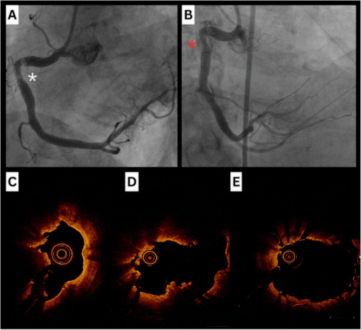 Vessel_Plus's tweet photo. ✨ Calcified Coronary Nodules
🔍 OCT/IVUS/CCTA for accurate diagnosis
🛠 Lesion prep: atherectomy, IVL, NC balloons
⚠ Risks: under-expansion, perforation, embolization
#CalcifiedNodules #CoronaryImaging #Cardiology #PCI #CABG

🔗 https://t.co/it23wZJriG https://t.co/WOb4AWDMnb