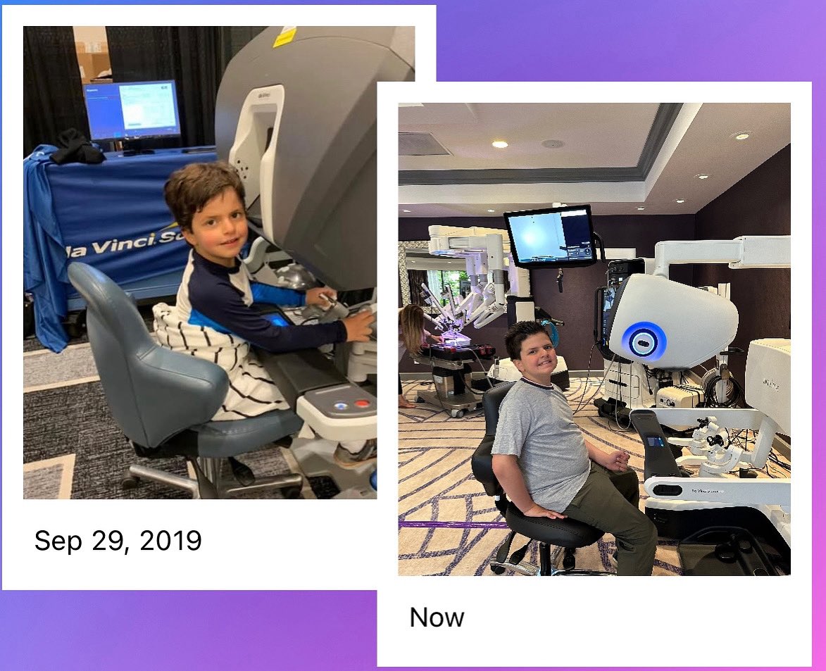 AhmadAbouAbbas8's tweet image. After six years, my son is older, and robotic surgery is much better! @IntuitiveSurg #roboticsurgery.