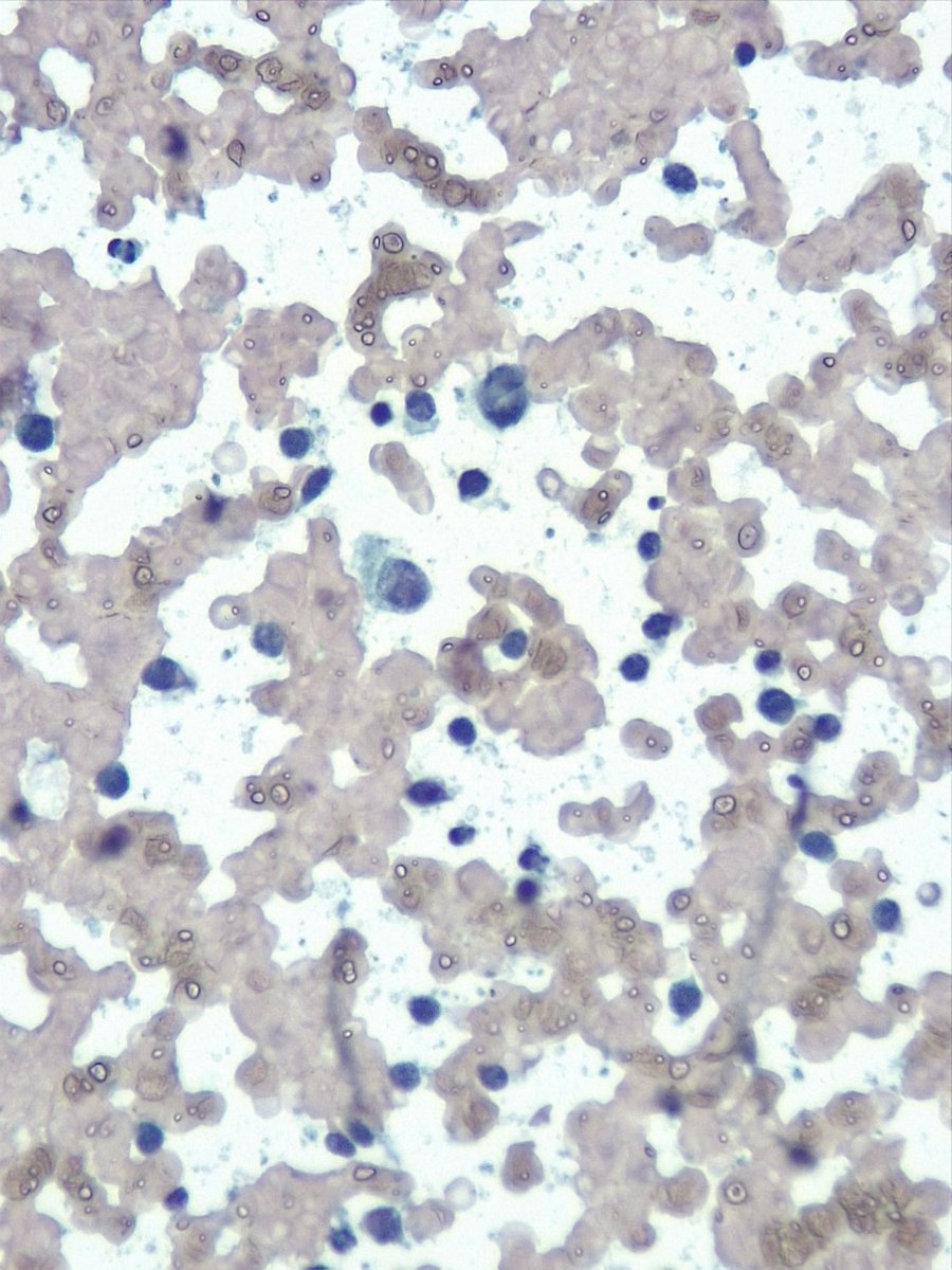 F, 62 yo. FNA of "transgastric nodule".

What do you think?