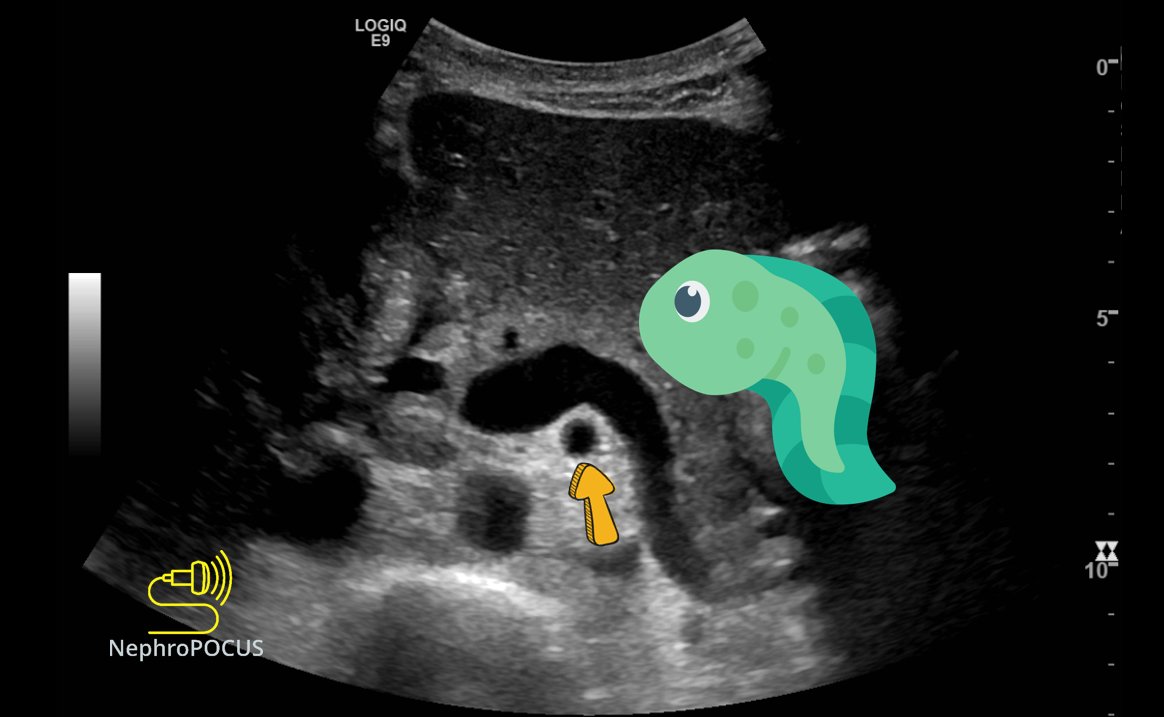 NephroPOCUS tweet media