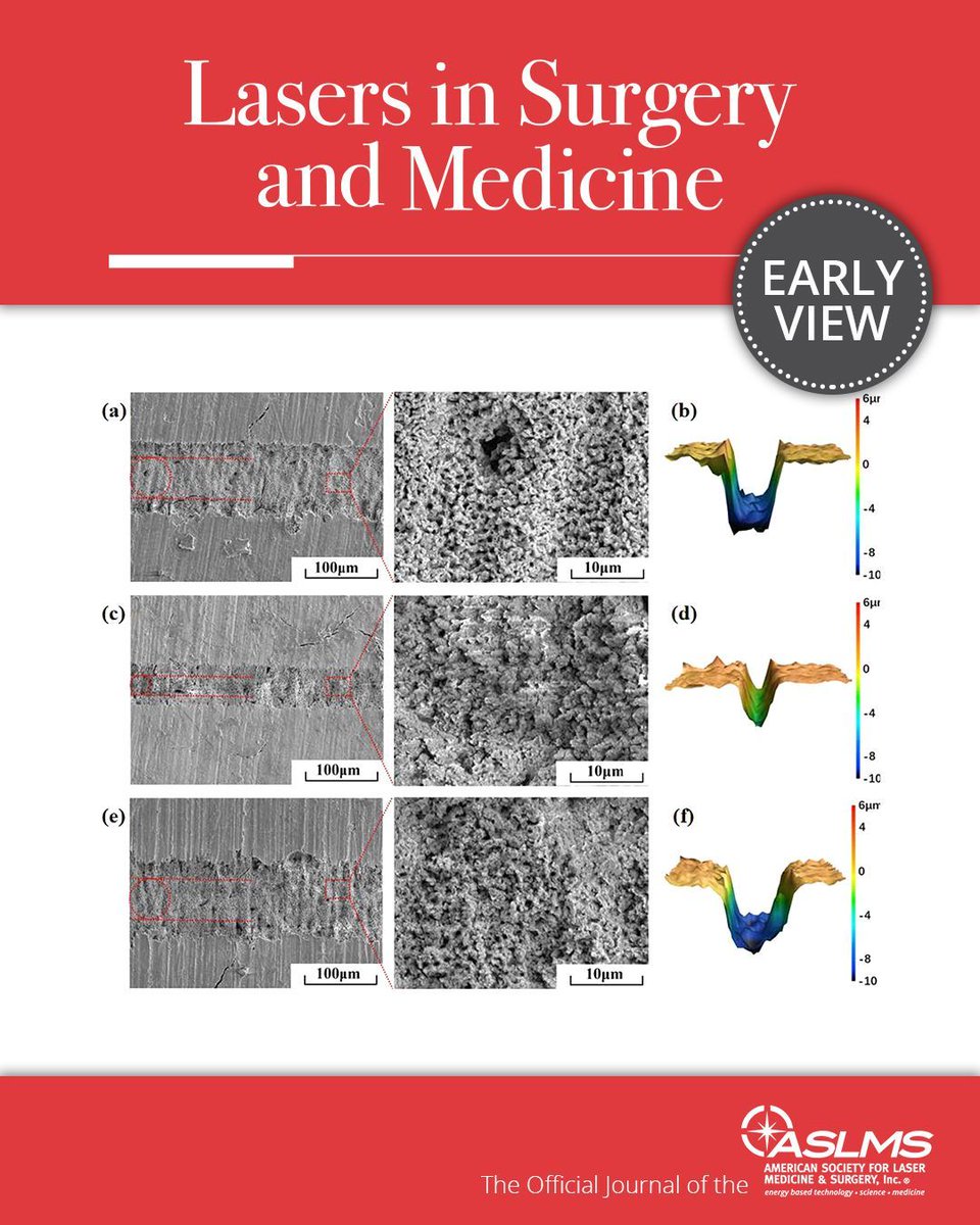 aslmsedu's tweet image. This basic science article investigates the ablation behaviors of bovine bone (storage in water) under different defocus distances using a femtosecond laser under ambient air conditions... ASLMS members, read the full article at aslms.org/library?path=d…

#femtosecond #ablationrate