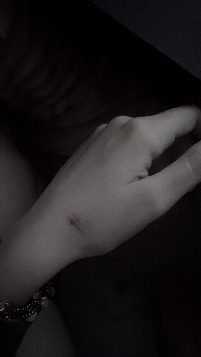 New hand scar, I tried multi swiping it but my blade is so dull and after it heals I’ll prob make a burn scar on top of it