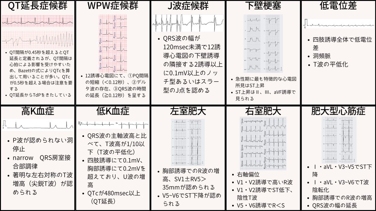 ecgkuma's tweet photo. 心電図40選、波形の特徴をまとめました。
VF、VT、TdP、WPW+af、af、PSVT、R on T、ST上昇、房室ブロック、洞不全症候群、洞頻脈、洞徐脈、洞不整脈、AFL、期外収縮、ブルガダ、QT延長、WPW、J波、低電位差、高K、低K、心肥大、心筋症、肺血栓塞栓症、右胸心、脚ブロック、たこつぼ、心筋梗塞、心膜炎 https://t.co/hJcA6Isxt6
