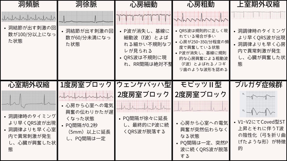 ecgkuma's tweet photo. 心電図40選、波形の特徴をまとめました。
VF、VT、TdP、WPW+af、af、PSVT、R on T、ST上昇、房室ブロック、洞不全症候群、洞頻脈、洞徐脈、洞不整脈、AFL、期外収縮、ブルガダ、QT延長、WPW、J波、低電位差、高K、低K、心肥大、心筋症、肺血栓塞栓症、右胸心、脚ブロック、たこつぼ、心筋梗塞、心膜炎 https://t.co/hJcA6Isxt6