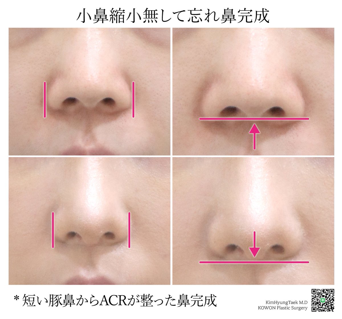 Dr.KimHT (コウォン整形外科) on X