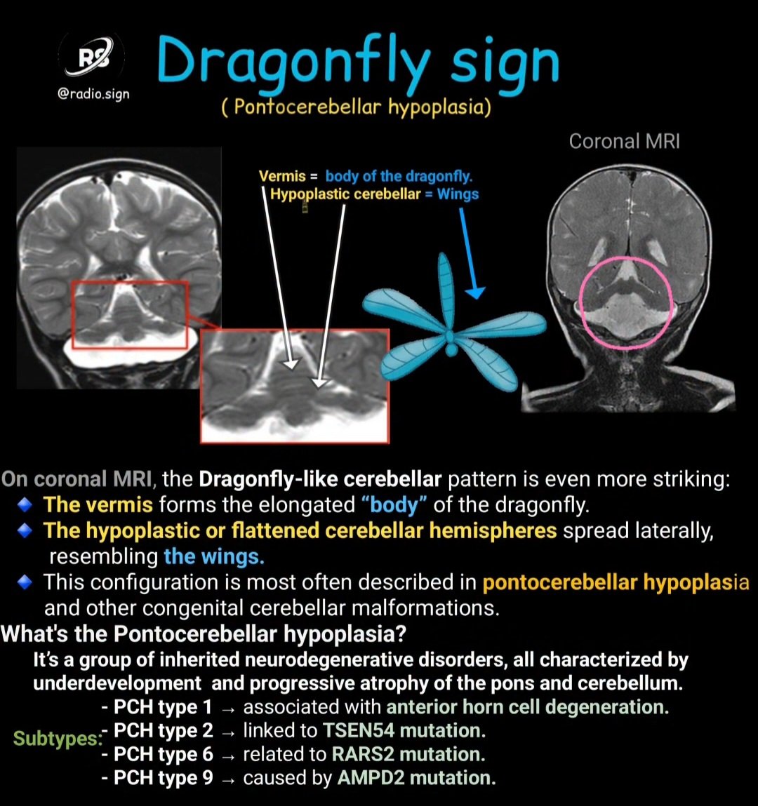 drsthanus's tweet photo. Dragonfly Sign (Pontocerebellar Hypoplasia).

https://t.co/evQ7FtttKP https://t.co/O18AEYBihp