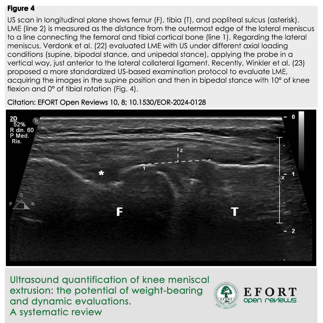 EFORTnet's tweet photo. #Ultrasound a reliable tool for quantifying #knee #meniscalextrusion
Its unique ability to perform weight-bearing & dynamic evaluations offers valuable insights that #MRI can't
๐https://t.co/z1raK0K5rP
#EFORT #EORJournal #Traumatology #MedicalResearch #Radiology #SportsMedicine https://t.co/QPNtAm1S31
