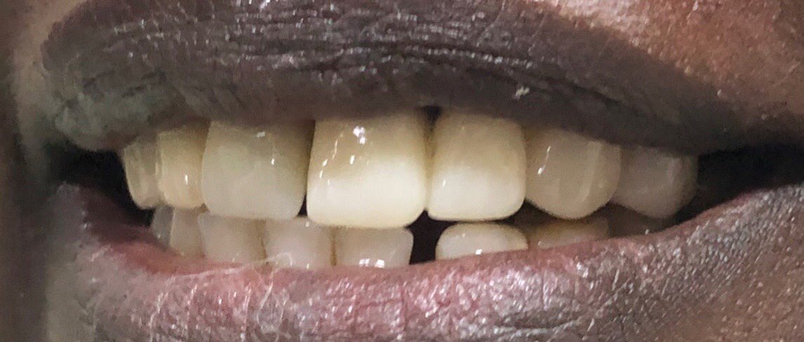 Implants are the modern way to replace your missing teeth and they are quick and simple to make