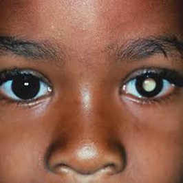 CancerProgramKE's tweet image. Children with cancer may not always show symptoms. Early detection and treatment improve outcomes. All children under 5 should be screened for Retinoblastoma (eye cancer) during routine MCH clinic visits.
#ChildhoodCancerAwarenessMonth
#CCAM2025