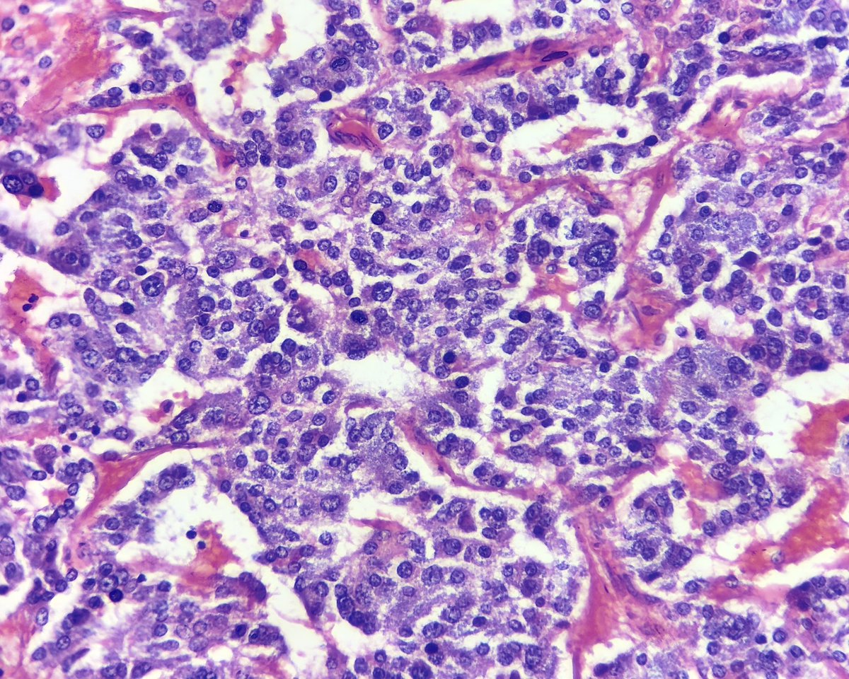 megha_lalcheta's tweet image. Adrenal mass, 60/F. 

#Endopath #Surgpath #Pathology #Pathresidents #PathX #Pathtwitter #Adrenal 
Your opinion?