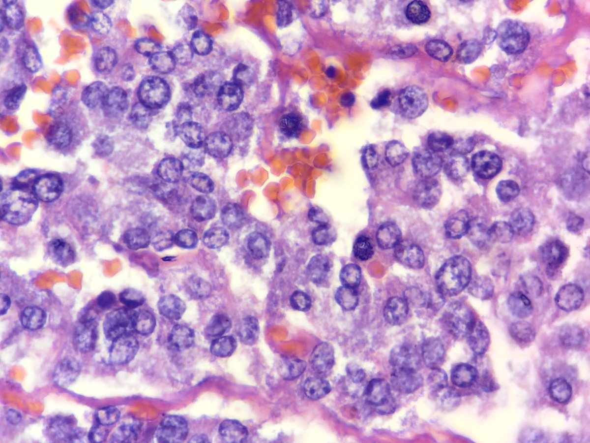 megha_lalcheta's tweet image. Adrenal mass… #Endopath 
Microscopic images…..