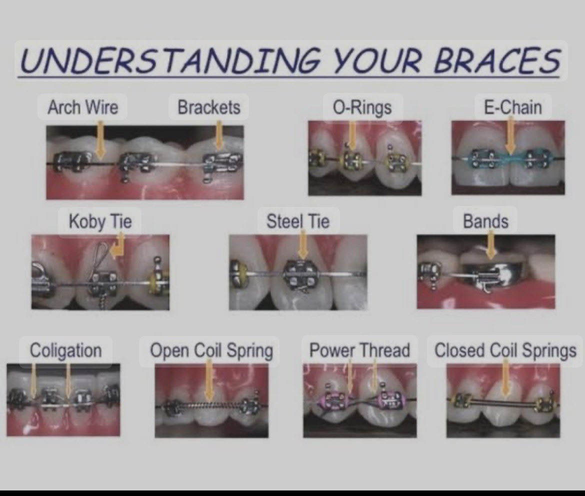 Braces aren’t just about looks🦷Braces straighten teeth, improve your bite and protect long-term oral health ✨with proper care 🪥and regular checkups, you will love your results! whether teen or an adult, it’s never too late to start your journey. Contact us  on  0772556919