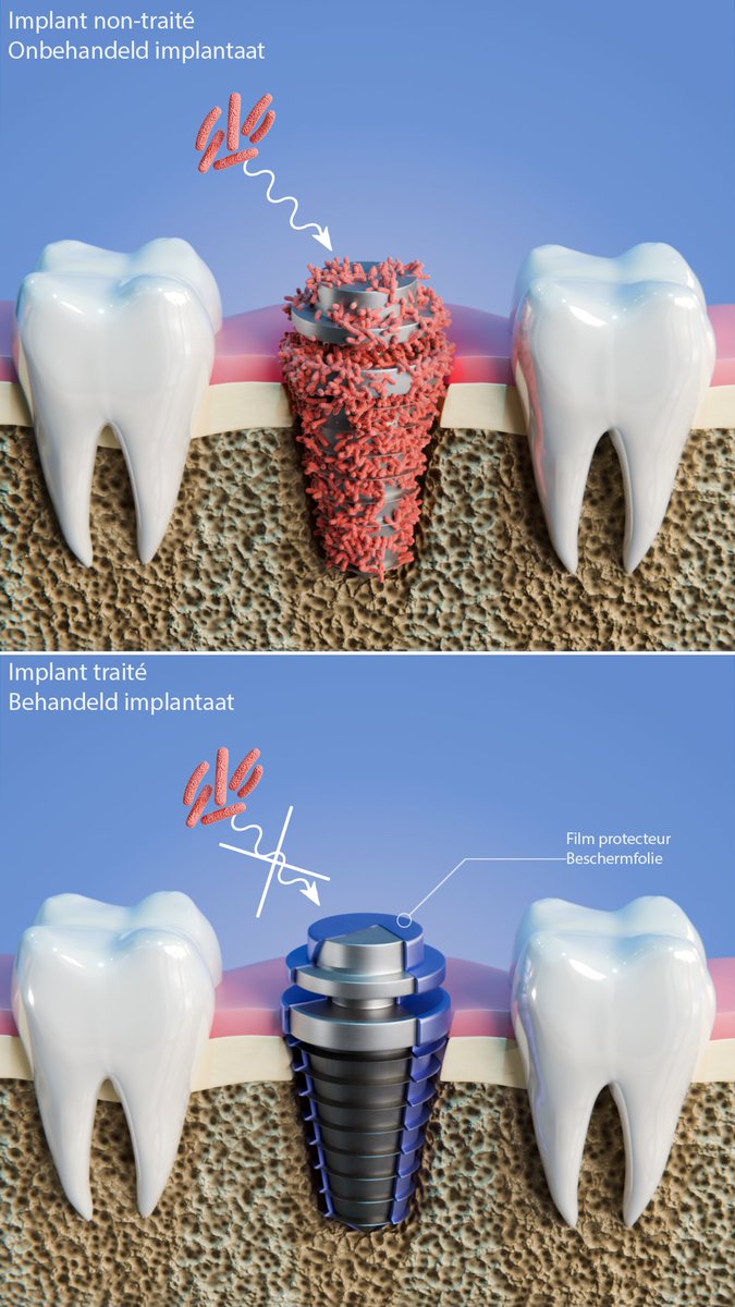 SAFE - Des implants plus sûrs grâce aux procédés plasma. Un projet #Interreg France–Wallonie–Vlaanderen pour innover et protéger la santé.
SAFE - Veiligere implantaten via plasma, een #Interreg-project voor innovatie &amp; gezondheid.
👉 safe-interreg.eu/projet-safe/
#santé #gezondheid