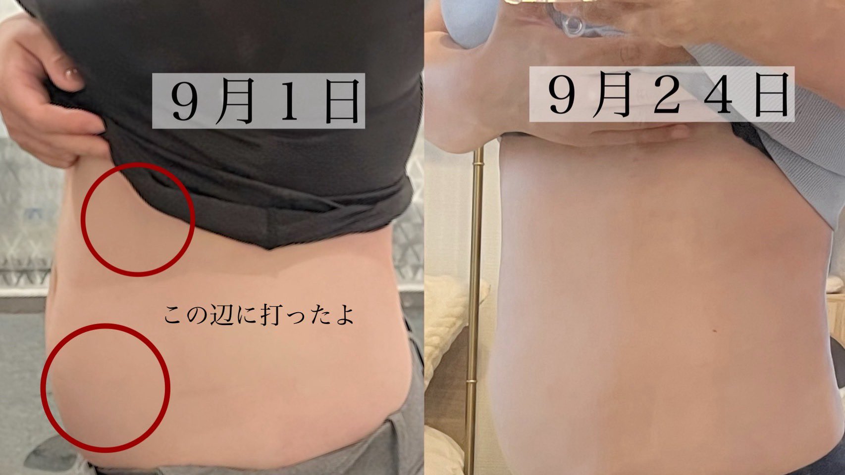 プランエスクリニック　ダイブイン おむすび ┊ 30代の美容探偵 ⸝⸝ᵕ̈* on X: 
