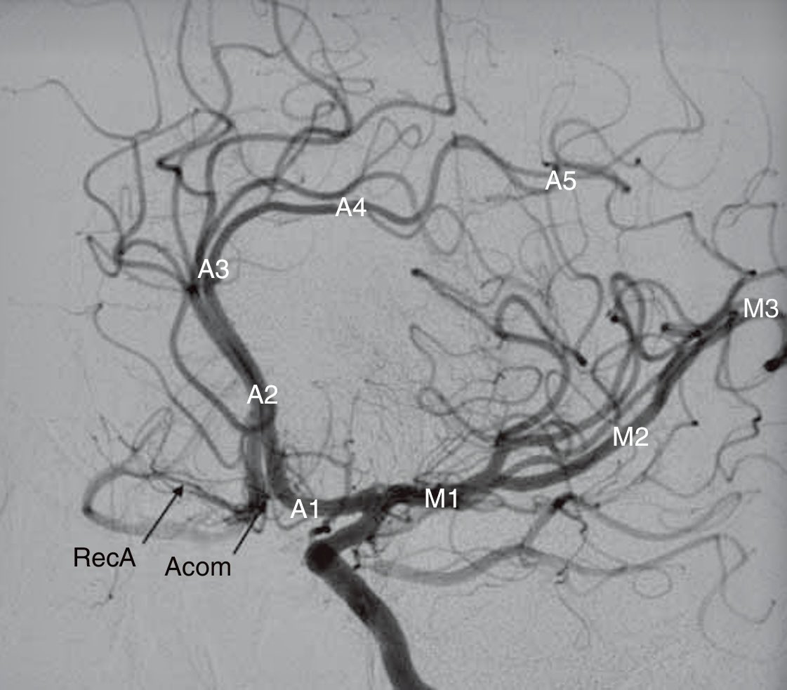 Seraj Ajaj (@seraj25) on Twitter photo An oblique view demonstrates the classification schemes of the anterior cerebral artery and the middle cerebral artery.
A, Anterior cerebral artery
M, Middle cerebral artery 
RecA, Recurrent artery of Heubner
Acom, Anterior communicating artery An oblique view demonstrates the classification schemes of the anterior cerebral artery and the middle cerebral artery.
A, Anterior cerebral artery
M, Middle cerebral artery 
RecA, Recurrent artery of Heubner
Acom, Anterior communicating artery