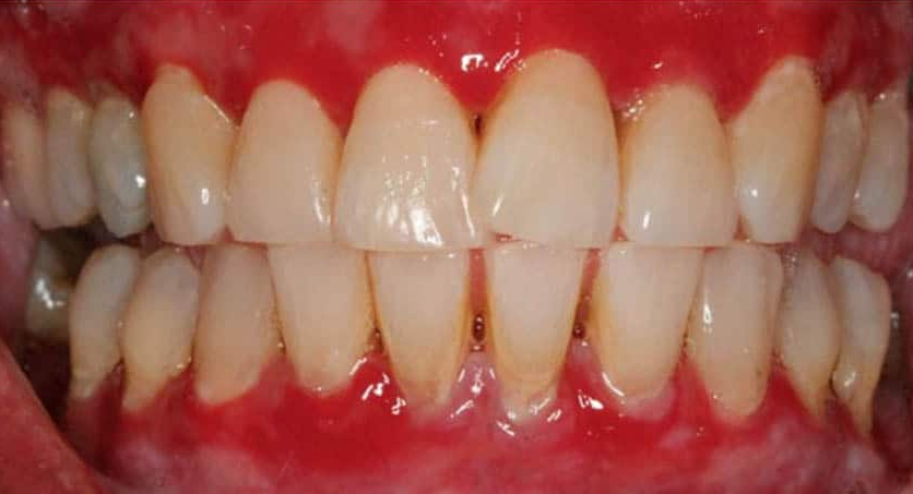 drdrumi's tweet image. 🦷Bleeding gums? Don’t freak out—keep brushing! Skipping only makes gingivitis party harder. Be gentle, be consistent, and show those gums who’s boss. 🪥🦷 #dentalcare #teethtips