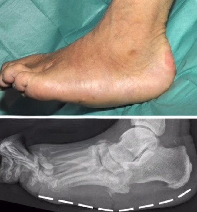 nervemed's tweet image. What is the most likely diagnosis❓

A. Gout
B. Osteoporosis
C. Diabetes mellitus
D. Rheumatoid arthritis