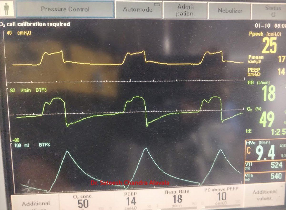 How would you interpret this waveform?

#mechanicalventilation
#ventilatorwaves