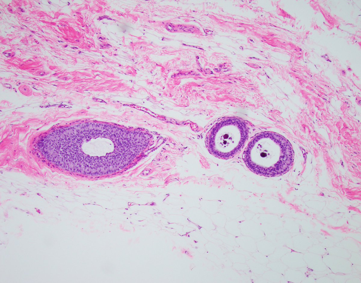 Happy Tuesday everyone! 

Let's jump right into Breast Consult Case of the Week 5 #BCCW #breastpath

This is a 50 year old patient with non mass enhancement on MR.

What is the referring pathologist's question? What is your answer? Different images from different cores.