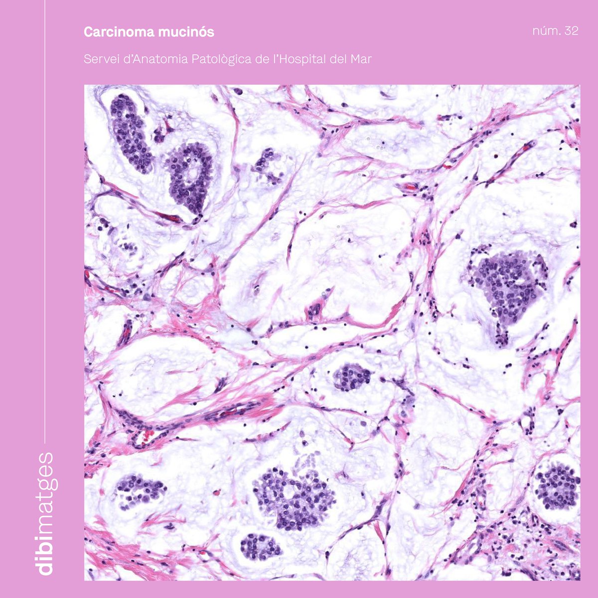 Dibi· Xarxa de diagnòstic biomèdic i per la imatge (@dibixarxa) on Twitter photo 🔬 #dibimatge | Secció histològica d'un carcinoma mucinós, realitzada pel Servei d’Anatomia Patològica de l'<a href="/hospitaldelmar/">Hospital del Mar</a>, integrat a #xarxadibi
S'observen cèl·lules tumorals en nius, envoltades de material mucoide. Aquestes lesions són més freqüents en dones d'edat avançada. 🔬 #dibimatge | Secció histològica d'un carcinoma mucinós, realitzada pel Servei d’Anatomia Patològica de l'<a href="/hospitaldelmar/">Hospital del Mar</a>, integrat a #xarxadibi
S'observen cèl·lules tumorals en nius, envoltades de material mucoide. Aquestes lesions són més freqüents en dones d'edat avançada.