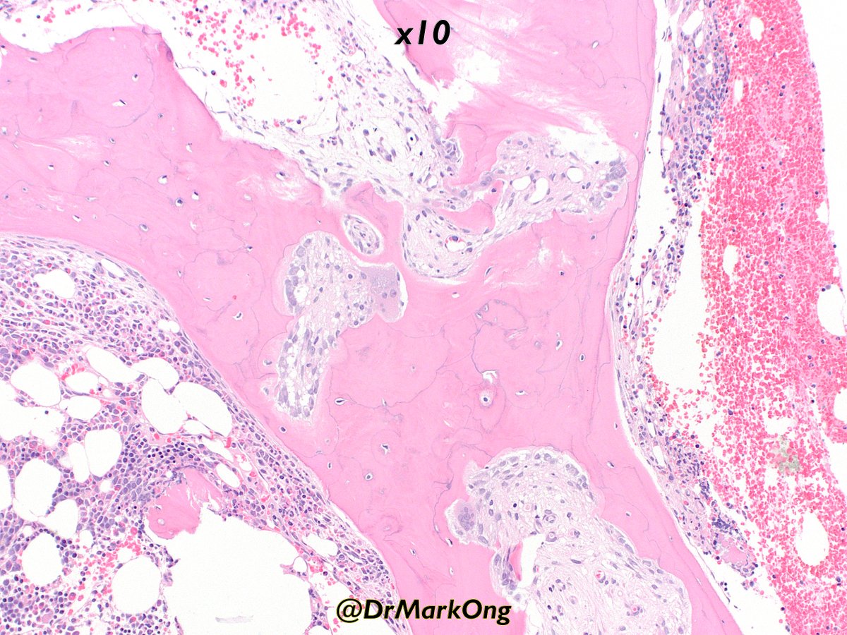 DrMarkOng's tweet photo. Bone marrow from elderly adult with end-stage renal failure.

Peri-trabecular fibrosis. Numerous osteoblasts, occasional osteoclasts. Dips in the bony trabeculae indicate bone resoprtion, but at the same time, abundant new bone formation (= woven rather than lamellar bone). https://t.co/OiLSHw43ps