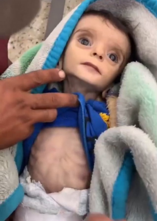 "تحولت لهيكل عظميّ".. إرتقاء طفلة في مدينة غزة بسبب التجويع الممنهج من الاحتلال النازي و سوء التغذية ونقص العلاج في القطاع وسط استمرار الإبادة والتجويع القسريّ.

ستكون خصيم لكل متخاذل يوم القيامة.