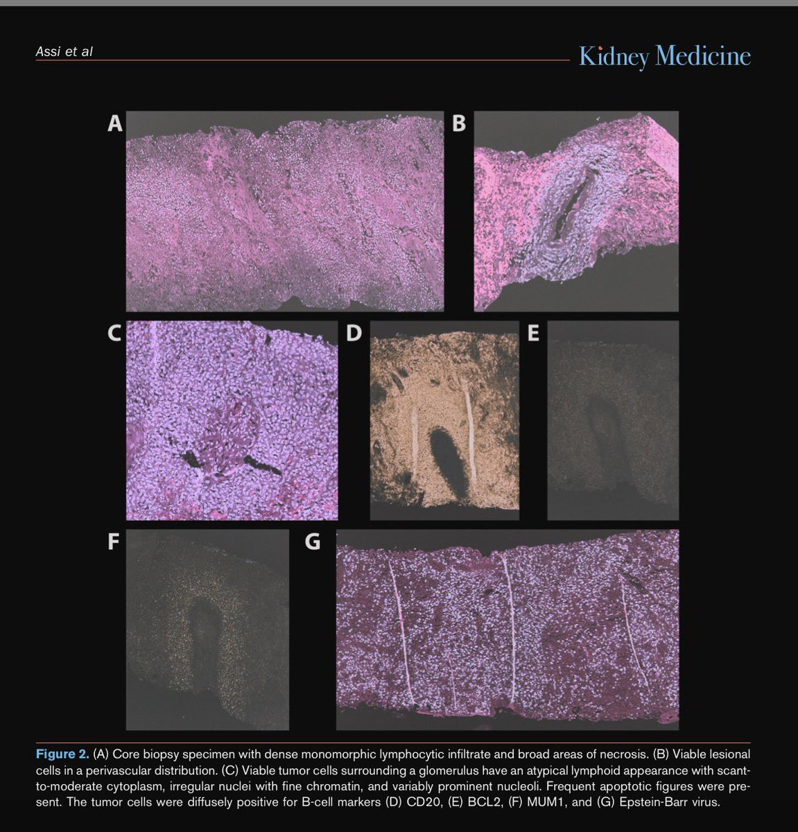 👏 Congratulations to Ismael Assi, second year medical student, for leading this important publication in Kidney Medicine!

🚨 Acute-onset PTLD just 7 weeks after kidney transplant
🔹 EBV– recipient, EBV+ donor,  HLA mismatch
🔹 Complicated by bacteremia + fungemia
🔹 Tx: