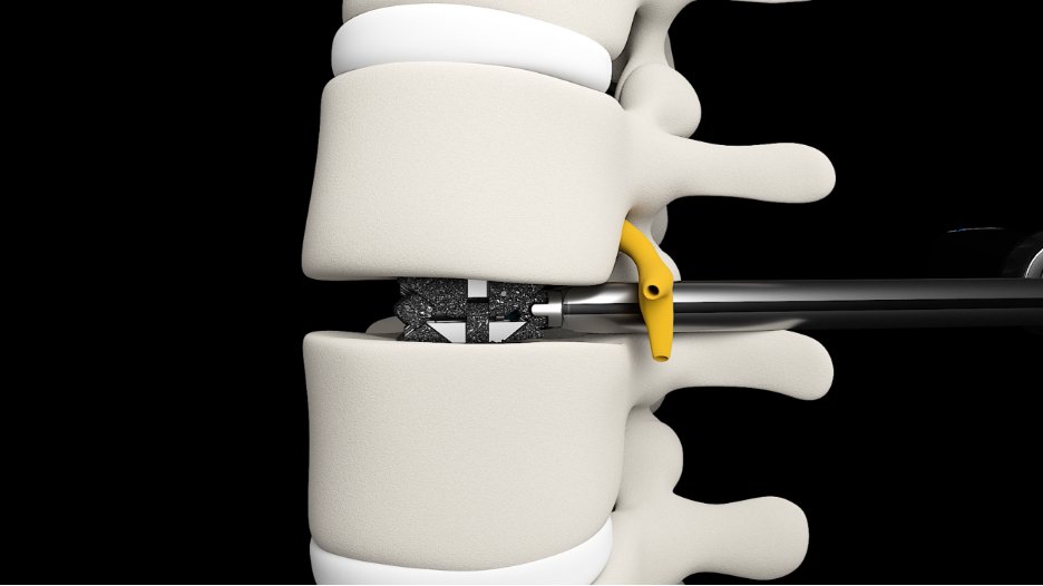 Life Spine, Inc. tweet media